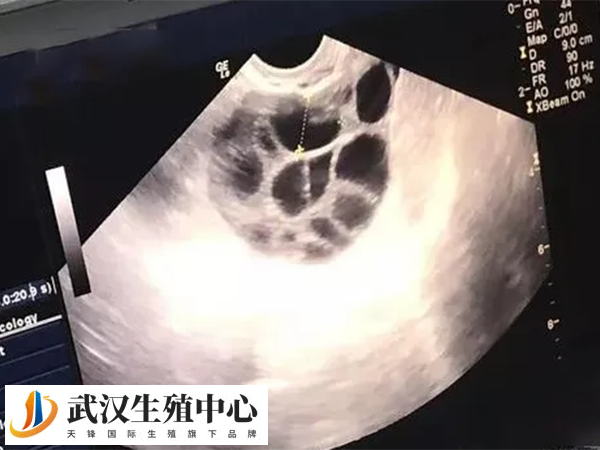 女性的原始卵泡是与生俱来的
