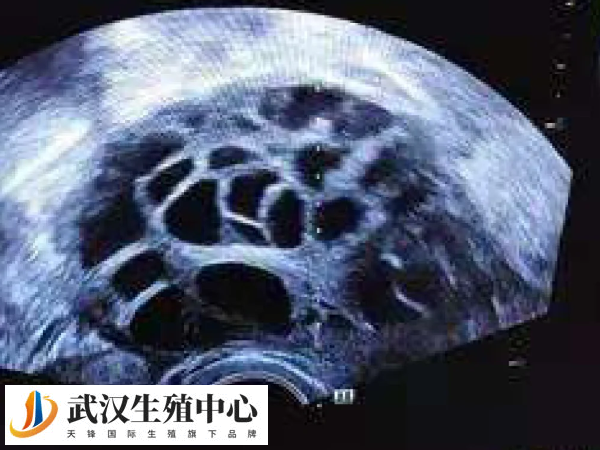 促排卵泡17*16可以打破卵针