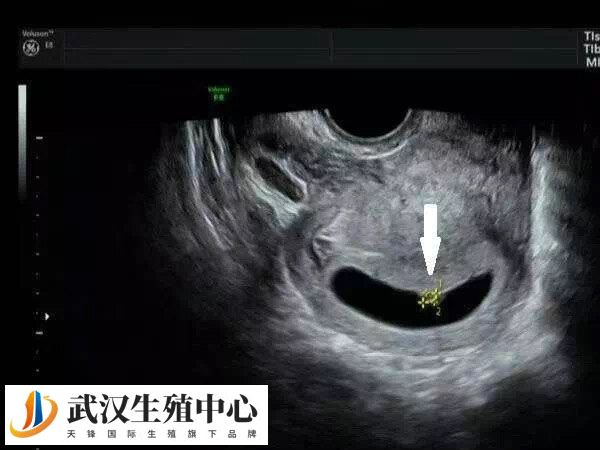 减肥有利于改善妊娠结局