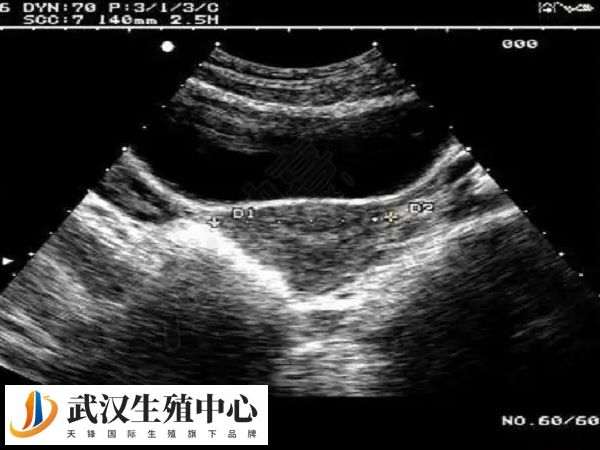 高fsh是会对怀孕带来一定的影响