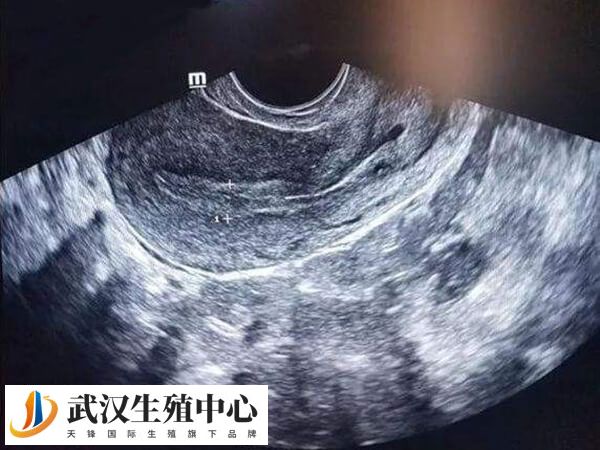 如何提高试管移植的成功率