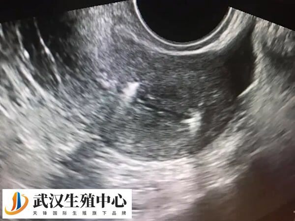 宫腔分离可能会对受孕产生一定影响